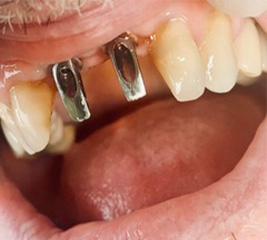 close up of mouth with implant bases for the top two front teeth