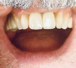 close up of mouth with a completed smile