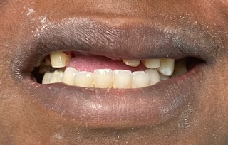 close up of mouth with implant bases for the top two front teeth