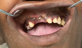 close up of mouth missing their top two front teeth