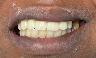 close up of mouth with a completed smile
